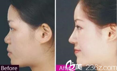 金英祖院長(zhǎng)隆鼻案例 金英祖院長(zhǎng)隆鼻案例