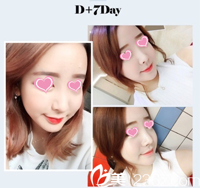 臥蠶14后天恢復(fù)效果