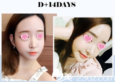 自體脂肪填充全臉一個(gè)月后