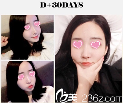 醫(yī)美顧問分享自己在韓國自然主義整形醫(yī)院找高應(yīng)烈做自體脂肪填充全臉+臥蠶后的恢復(fù)效果