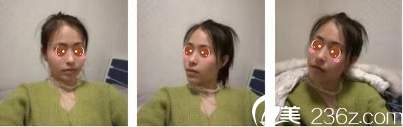 韓國Toxnfill整形外科宋仁權瘦臉除皺瘦真人案例術前照 韓國Toxnfill整形外科宋仁權瘦臉除皺瘦真人案例術前照