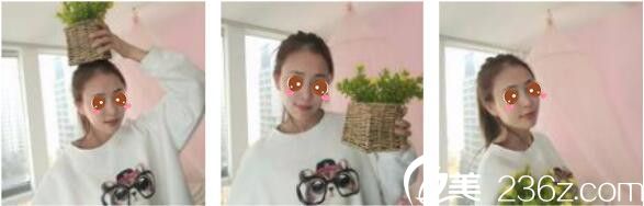 韓國Toxnfill整形外科宋仁權瘦臉除皺瘦真人案例術后十五天 韓國Toxnfill整形外科宋仁權瘦臉除皺瘦真人案例術后十五天