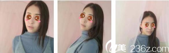 韓國Toxnfill整形外科宋仁權瘦臉除皺瘦真人案例術后一個月 韓國Toxnfill整形外科宋仁權瘦臉除皺瘦真人案例術后一個月