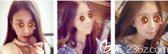 韓國Toxnfill整形外科宋仁權瘦臉除皺瘦真人案例術后兩個月 韓國Toxnfill整形外科宋仁權瘦臉除皺瘦真人案例術后兩個月