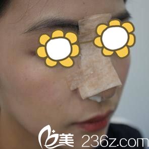 找金均泰做鼻整形術后第2天