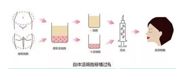 自體脂肪移植過程 自體脂肪移植過程