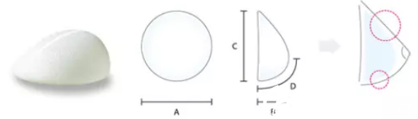 假體隆胸手術(shù) 假體隆胸手術(shù)