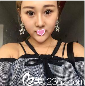 在北京知音做眼綜合第23天 在北京知音做眼綜合第23天