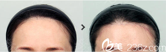 韓國TAILOR卓佑炫整形內(nèi)視鏡額頭提升術(shù)案例對比圖 韓國TAILOR卓佑炫整形內(nèi)視鏡額頭提升術(shù)案例對比圖