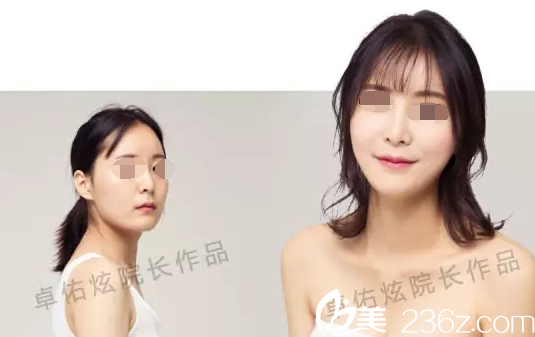 卓佑炫院長面部整形案例 卓佑炫院長面部整形案例