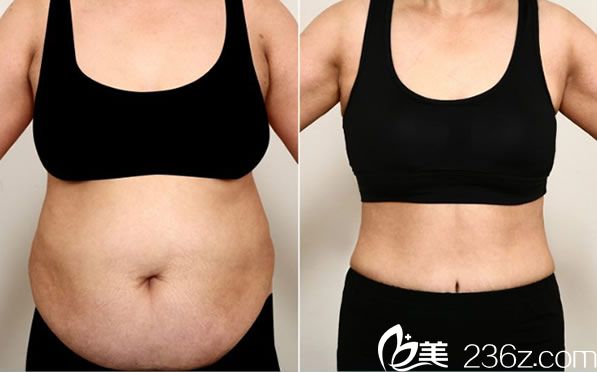 樸炳春院長全身吸脂<span style= 樸炳春院長全身吸脂<span style=