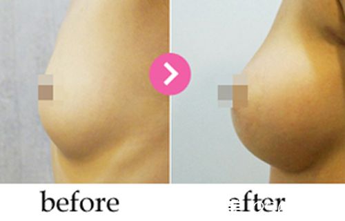 韓國德美特(mentor)整形醫(yī)院隆胸案例對(duì)比圖 韓國德美特(mentor)整形醫(yī)院隆胸案例對(duì)比圖