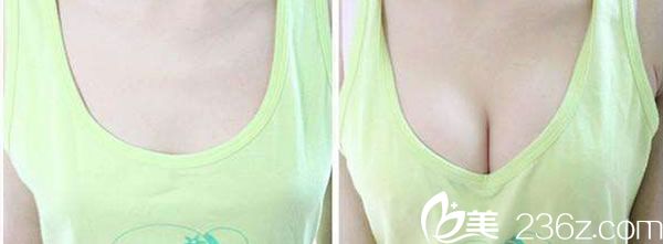 自體脂肪隆胸前后<span style= 自體脂肪隆胸前后<span style=