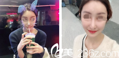 術(shù)后18天水腫消失