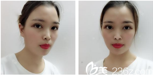 雙眼皮開(kāi)眼角術(shù)后三天效果圖 雙眼皮開(kāi)眼角術(shù)后三天效果圖