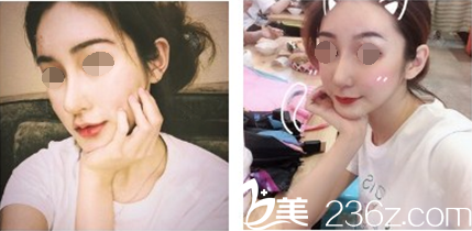 在韓國卓佑炫整形做內(nèi)窺鏡提升后 額頭光滑 抬頭紋消失 告別肌膚松弛下垂