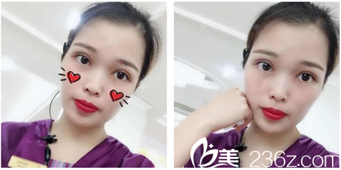 分享我找深圳美加美整形醫(yī)院陳群醫(yī)生做雙眼皮開(kāi)眼角的變美經(jīng)歷給大家