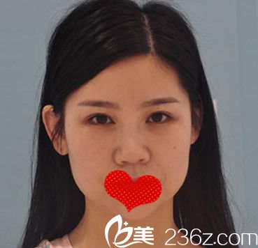 合肥安妮薇爾整形鼻綜合+雙眼皮修復(fù)術(shù)前照 合肥安妮薇爾整形鼻綜合+雙眼皮修復(fù)術(shù)前照