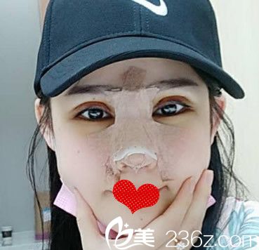 李繼銀肋軟骨鼻綜合+雙眼皮失敗修復(fù)第1天圖 李繼銀肋軟骨鼻綜合+雙眼皮失敗修復(fù)第1天圖