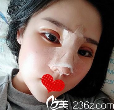 安妮薇爾整形雙眼皮失敗修復(fù)+肋軟骨鼻綜合第3天恢復(fù)情況 安妮薇爾整形雙眼皮失敗修復(fù)+肋軟骨鼻綜合第3天恢復(fù)情況