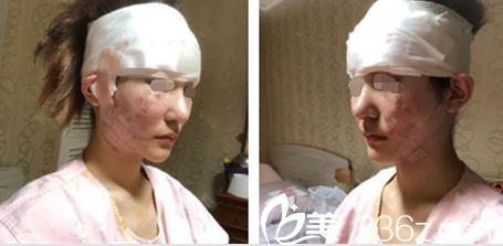 內(nèi)窺鏡手術(shù)天面部裹著紗布