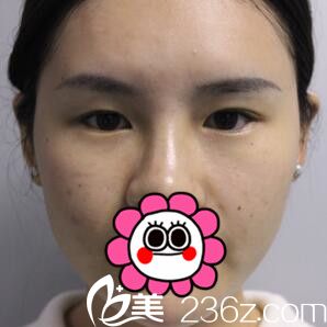 在韓國江南U&I整形外科做雙眼皮開眼角術(shù)前照 在韓國江南U&I整形外科做雙眼皮開眼角術(shù)前照