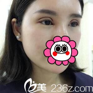 雙眼皮+開眼角術(shù)后當天照 雙眼皮+開眼角術(shù)后當天照