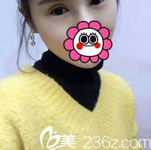 割雙眼皮+開眼角術(shù)后一周拆線 割雙眼皮+開眼角術(shù)后一周拆線