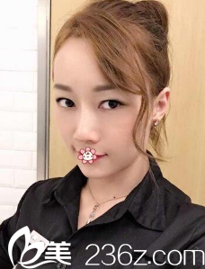 <!--<i data=20240703-sp></i>-->做自體脂肪填充怎么樣 <!--<i data=20240703-sp></i>-->做自體脂肪填充怎么樣