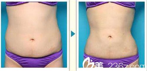 韓政憲院長吸脂瘦腰真人案例 韓政憲院長吸脂瘦腰真人案例