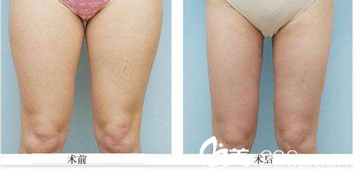 韓政憲院長吸脂瘦腿真人案例 韓政憲院長吸脂瘦腿真人案例