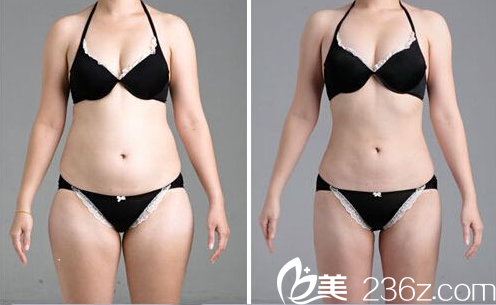 樸炳春院長全身抽脂效果案例 樸炳春院長全身抽脂效果案例