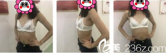 韓國UMNAGUMO整形外科嚴順燦自體脂肪隆胸真人案例術(shù)前照 韓國UMNAGUMO整形外科嚴順燦自體脂肪隆胸真人案例術(shù)前照