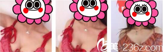 韓國UMNAGUMO整形外科嚴順燦自體脂肪隆胸真人案例術(shù)后一個月 韓國UMNAGUMO整形外科嚴順燦自體脂肪隆胸真人案例術(shù)后一個月