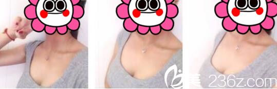 韓國UMNAGUMO整形外科嚴順燦自體脂肪隆胸真人案例術(shù)后兩個月 韓國UMNAGUMO整形外科嚴順燦自體脂肪隆胸真人案例術(shù)后兩個月