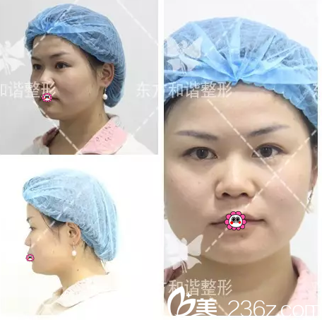 北京純脂醫(yī)療美容門診部馮斌術前照片1