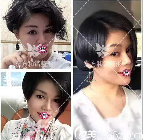 親身體驗北京純脂面部吸脂技術(shù)才明白找馮斌做臉部脂肪填充技術(shù)好也人不少原因