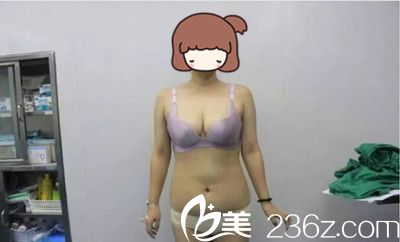 手術(shù)前正面照