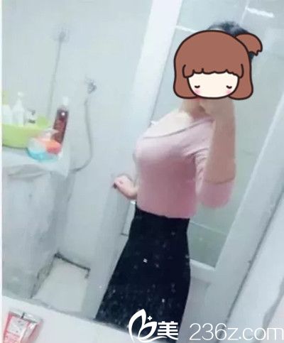 韓政憲院長吸脂手術(shù)真人案例