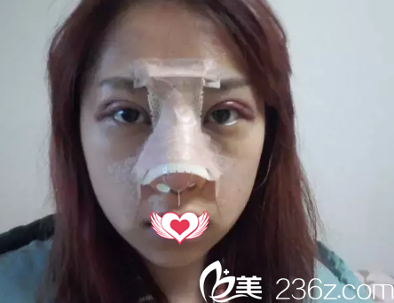 剛做完雙眼皮和隆鼻都很腫脹