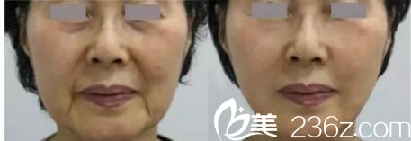 樸明旭面部線雕案例 樸明旭面部線雕案例