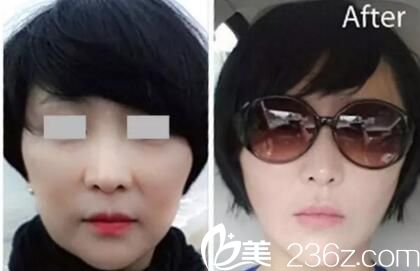 樸明旭面部年輕化案例 樸明旭面部年輕化案例