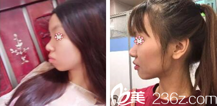 金日秀院長齙牙矯正案例