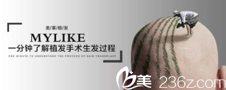 長(zhǎng)沙美萊毛發(fā)移植術(shù)過程