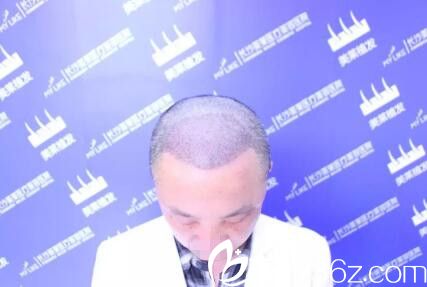 頭發(fā)移植術(shù)后2到3天樣子