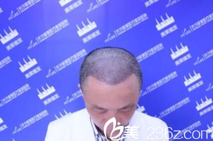 頭發(fā)移植后2-3周變化