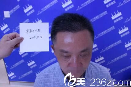 頭發(fā)移植4個(gè)月后效果