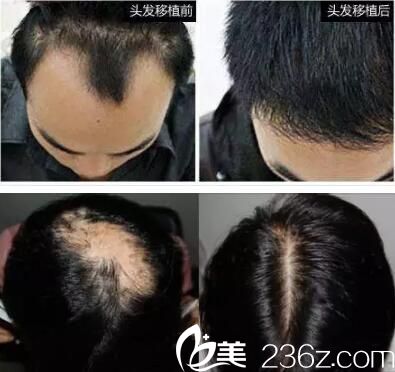 長(zhǎng)沙美萊頭發(fā)移植前后真人對(duì)比案例