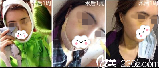 術(shù)后第五天 術(shù)后第五天