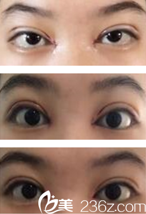 我的雙眼皮恢復(fù)過程 我的雙眼皮恢復(fù)過程